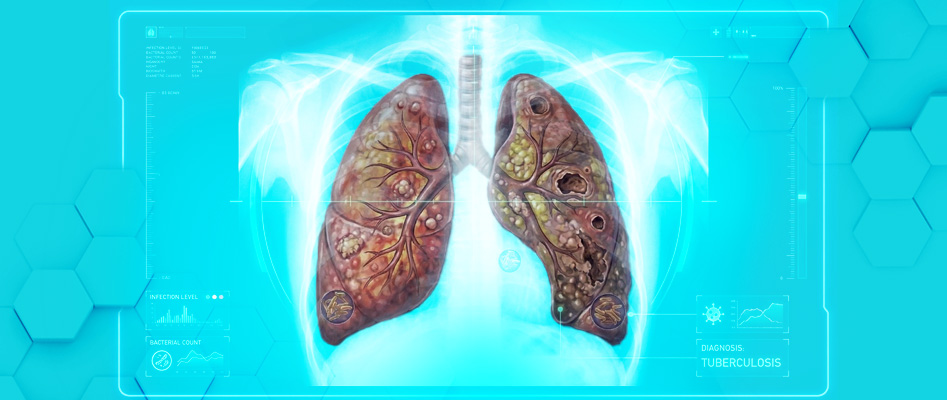 Verem (T�berk�loz)